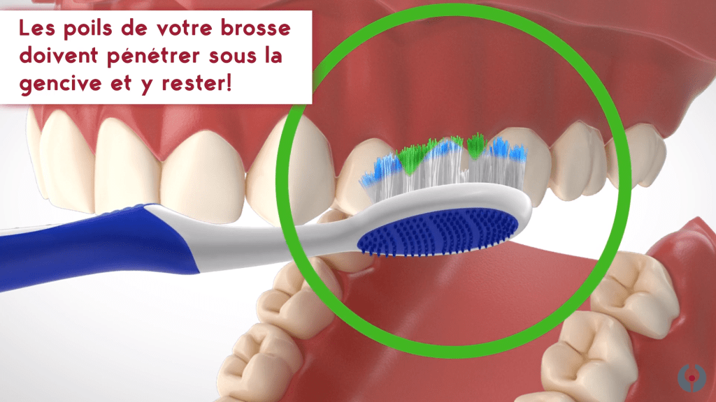Angle poils de la brosse à dent - Clinique Laflamme Leblanc - Dorval