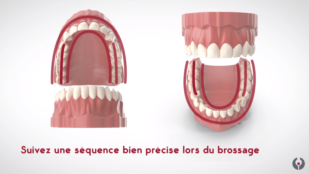 Séquence de brossage sulculaire - Clinique Laflamme Leblanc - Dorval